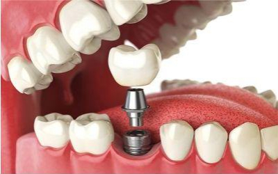 Implantes